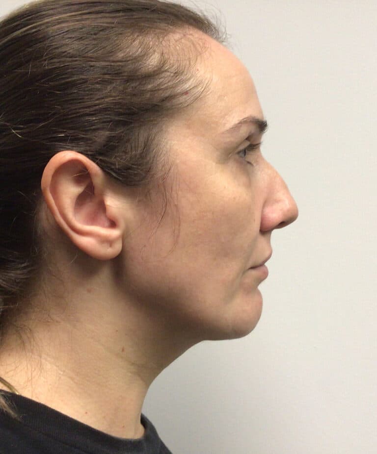 After Image: Chin Implant with Neck Liposuction - right-side