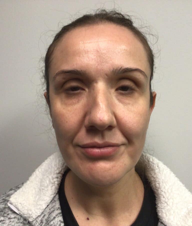 After Image: Chin Implant with Neck Liposuction - front