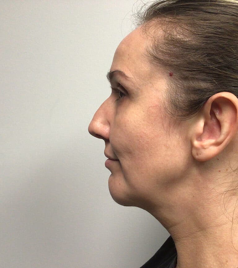 After Image: Chin Implant with Neck Liposuction - left-side