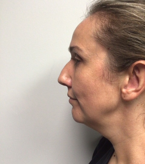 Before Image: Chin Implant with Neck Liposuction - left-side