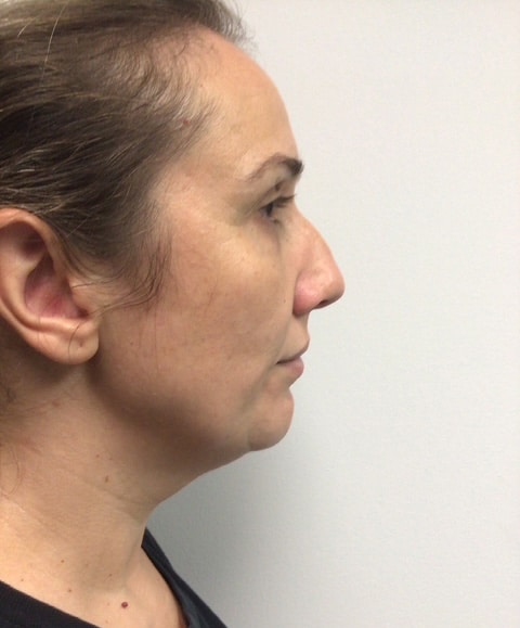 Before Image: Chin Implant with Neck Liposuction - right-side