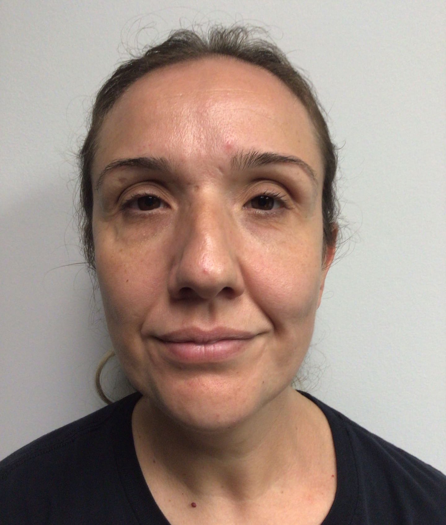 Before Image: Chin Implant with Neck Liposuction - front