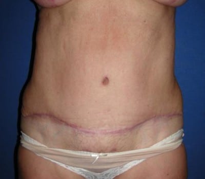 After Image: Abdominoplasty After Multiple Pregnancies - front
