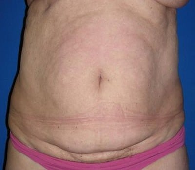 Before Image: Abdominoplasty After Multiple Pregnancies - front