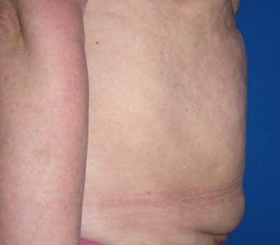 Before Image: Abdominoplasty After Multiple Pregnancies - other