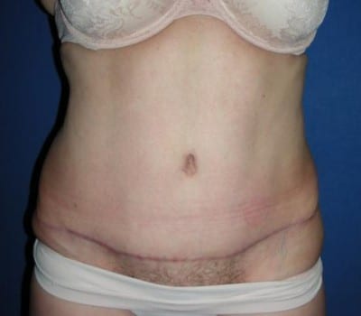 After Image: Abdominoplasty 3 Months Post-Op - front