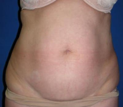 Before Image: Abdominoplasty 3 Months Post-Op - front