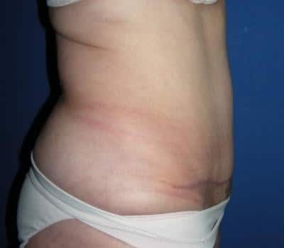 After Image: Abdominoplasty 3 Months Post-Op - other