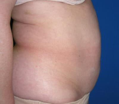 Before Image: Abdominoplasty 3 Months Post-Op - other