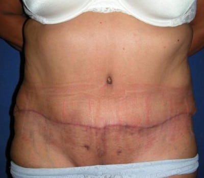 After Image: S/P Abdominoplasty - front
