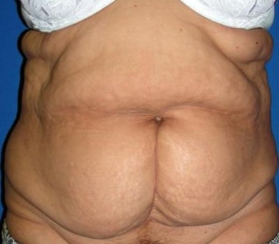 Before Image: S/P Abdominoplasty - front