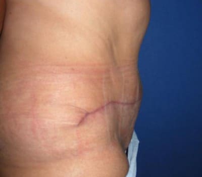 After Image: S/P Abdominoplasty - other