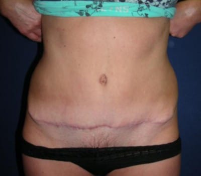 After Image: 43 Years Old Abdominoplasty - front