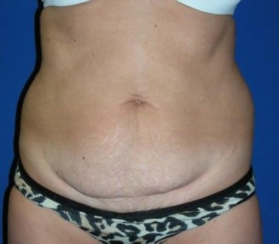 Before Image: 43 Years Old Abdominoplasty - front