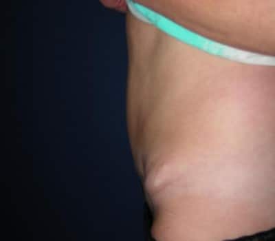 After Image: 43 Years Old Abdominoplasty - other