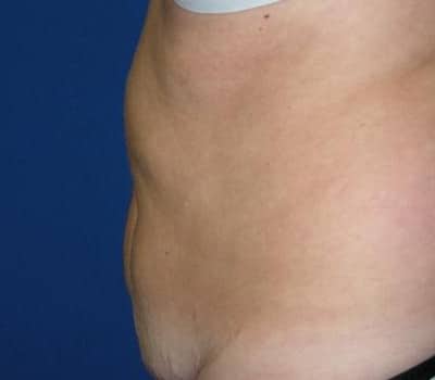 Before Image: 43 Years Old Abdominoplasty - other