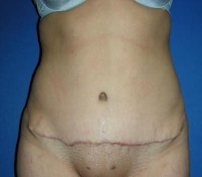 After Image: 35 Years Old 4 months Post-Op Abdominoplasty - front