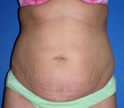 Before Image: 35 Years Old 4 months Post-Op Abdominoplasty - front