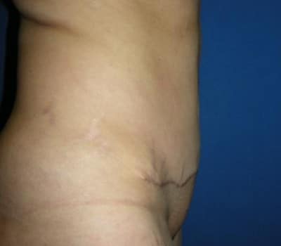 After Image: 35 Years Old 4 months Post-Op Abdominoplasty - other