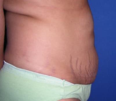 Before Image: 35 Years Old 4 months Post-Op Abdominoplasty - other