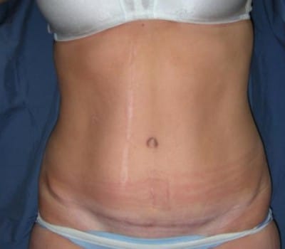 After Image: Routine Abdominoplasty - front