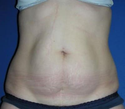 Before Image: Routine Abdominoplasty - front