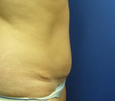 After Image: Routine Abdominoplasty - other