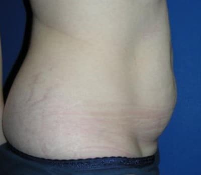 Before Image: Routine Abdominoplasty - other