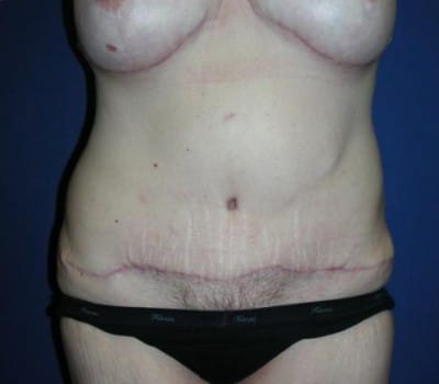 After Image: Breast & Abdominal Contouring - front