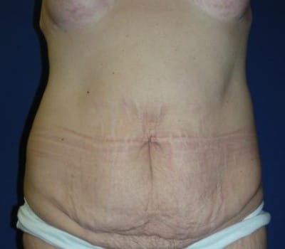 Before Image: Breast & Abdominal Contouring - front