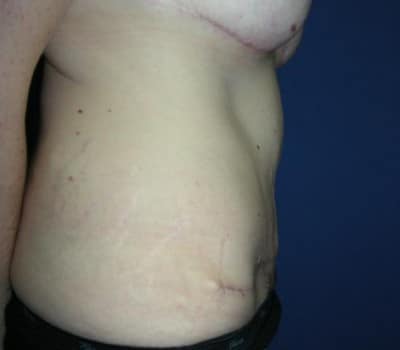 After Image: Breast & Abdominal Contouring - other
