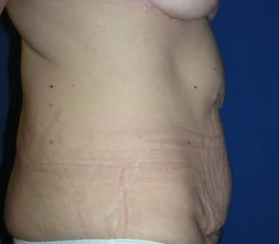 Before Image: Breast & Abdominal Contouring - other