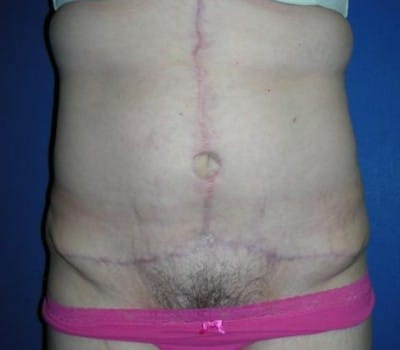 After Image: Fleur-de-lis Abdomioplasty - front