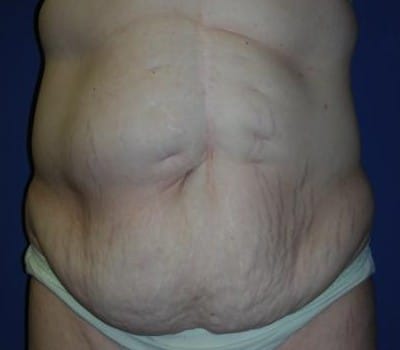 Before Image: Fleur-de-lis Abdomioplasty - front