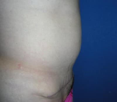 After Image: Fleur-de-lis Abdomioplasty - other