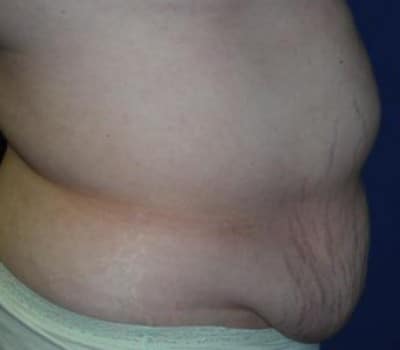 Before Image: Fleur-de-lis Abdomioplasty - other