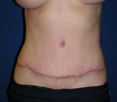 After Image: Abdominoplasty Simultaneou Lipo & Breast Aug - front