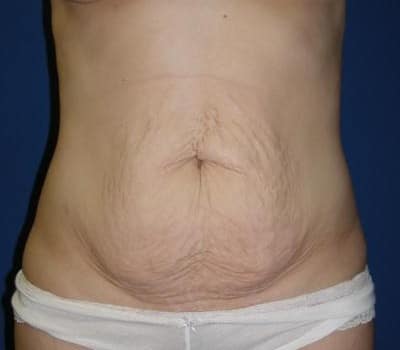 Before Image: Abdominoplasty Simultaneou Lipo & Breast Aug - front