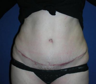 After Image: 45 Year Old 4 Months Post-Op Abdominoplasty - front