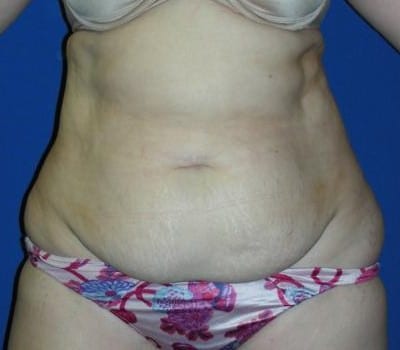 Before Image: 45 Year Old 4 Months Post-Op Abdominoplasty - front