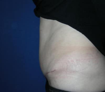 After Image: 45 Year Old 4 Months Post-Op Abdominoplasty - other