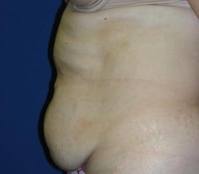 Before Image: 45 Year Old 4 Months Post-Op Abdominoplasty - other