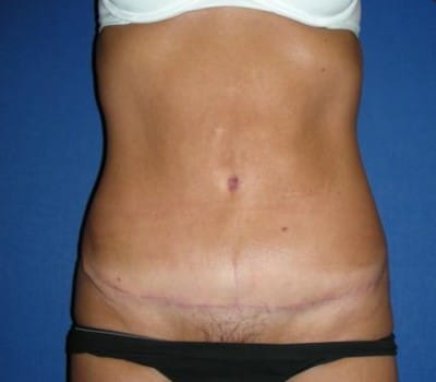 After Image: Abdominoplasty After Significant Weight Loss - front
