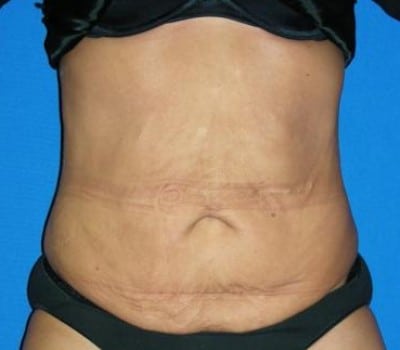 Before Image: Abdominoplasty After Significant Weight Loss - front