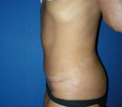 After Image: Abdominoplasty After Significant Weight Loss - other