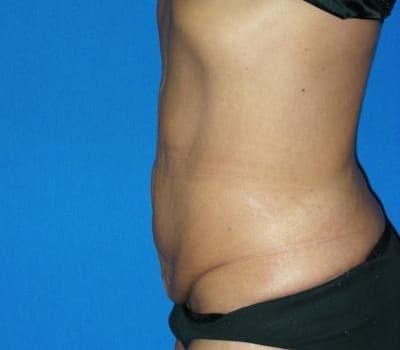Before Image: Abdominoplasty After Significant Weight Loss - other