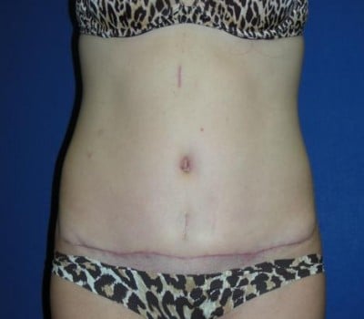 After Image: 6 Weeks Post-Op Abdominoplasty - front