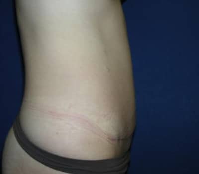 After Image: 6 Weeks Post-Op Abdominoplasty - other
