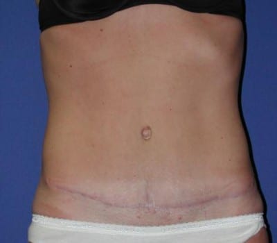 After Image: Abdominoplasty 3 Months Post-Op - front