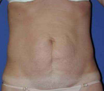 Before Image: Abdominoplasty 3 Months Post-Op - front